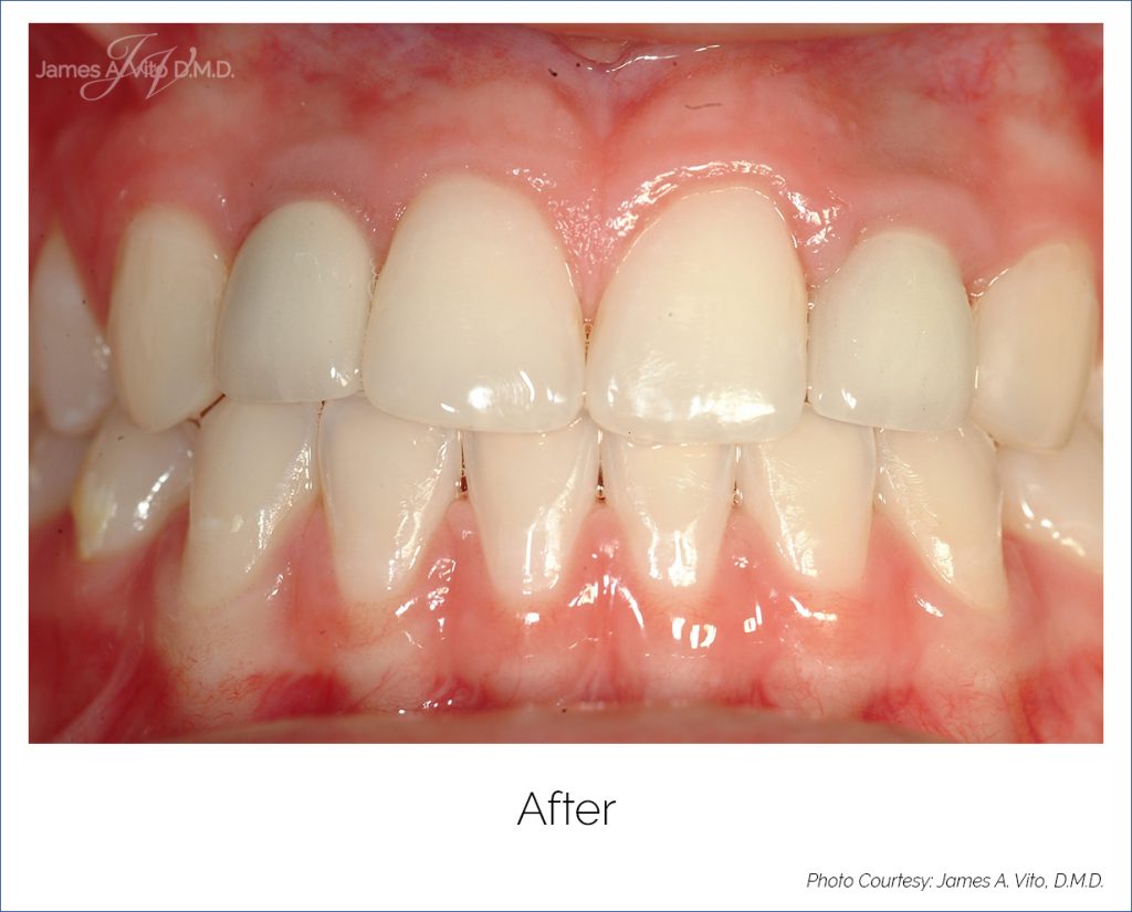 JAMES A VITO DMD Dental Implants Before & After